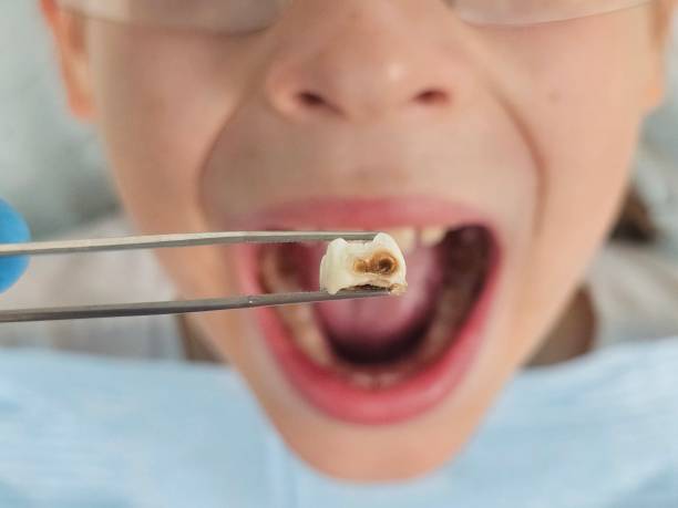 Best Emergency Dental Extractions in Summit View, WA